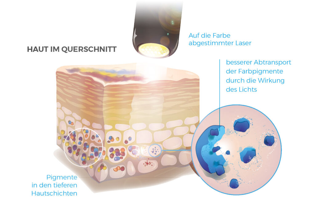 Infografik Pigment zersetzend