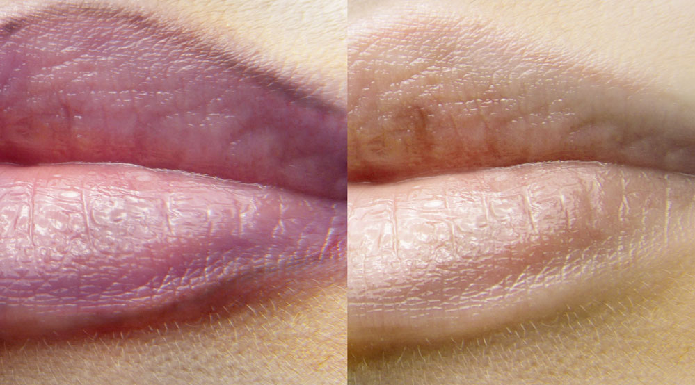 Before After Treatment PMU removal lips photos