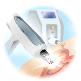 Illustration Bubble ND YAG laser tattoo removal