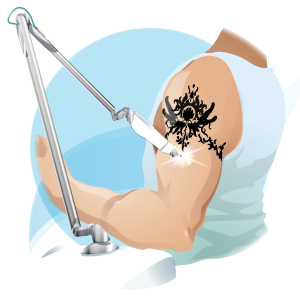 tattooremoval Picolaser Illustration 