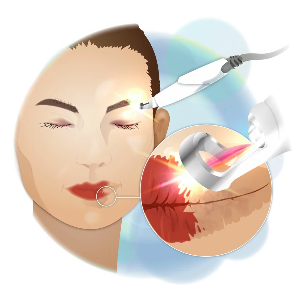 Grafik Anwendung Laser an Lippe und Augenbrauen